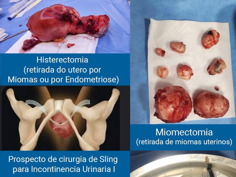 Cirurgias ginecológicas